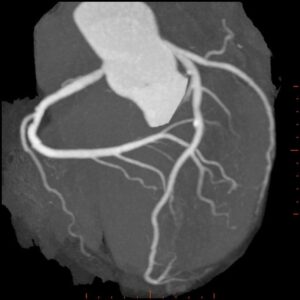 Kalp röntgen 